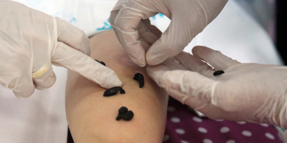 Sülük Tedavisi: Diyanet’in Görüşü ve Yararları