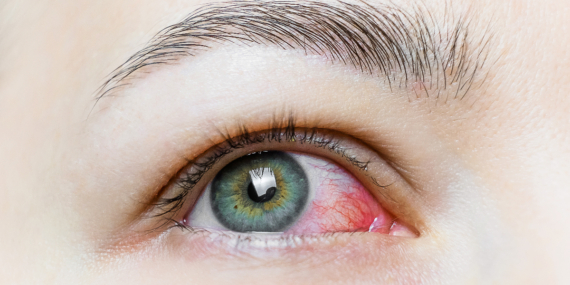 Sürekli Göz Sulanması: Dikkat Edilmesi Gerekenler