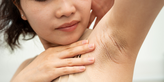 Ter Kokusunu Önlemenin Yolu: Beslenme İpuçları