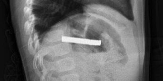 Erzurum’da Çocuk 19 Mıknatısı Yuttu!