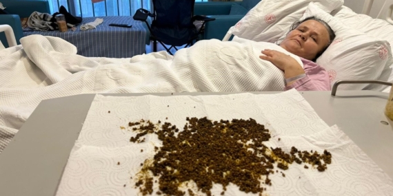 20 Bin Taşla Rekor Kıran Ameliyat Başarıyla Tamamlandı