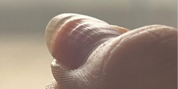 Tırnak Dalgalanmaları Sağlığınızın İşareti!